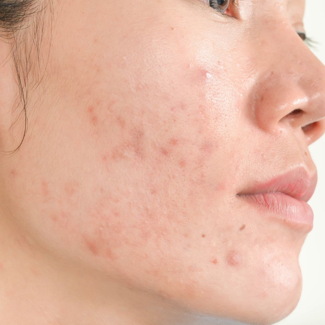 Acne Scars Treatments