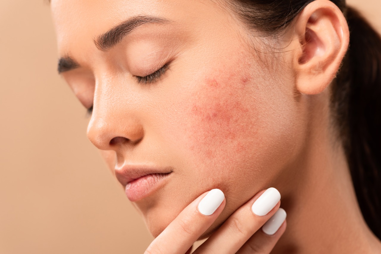 removal of acne scars in Kolkata