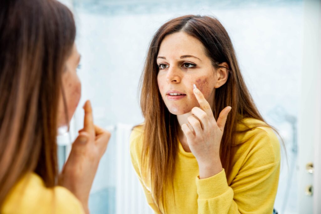 Removal of Acne Scars in Kolkata