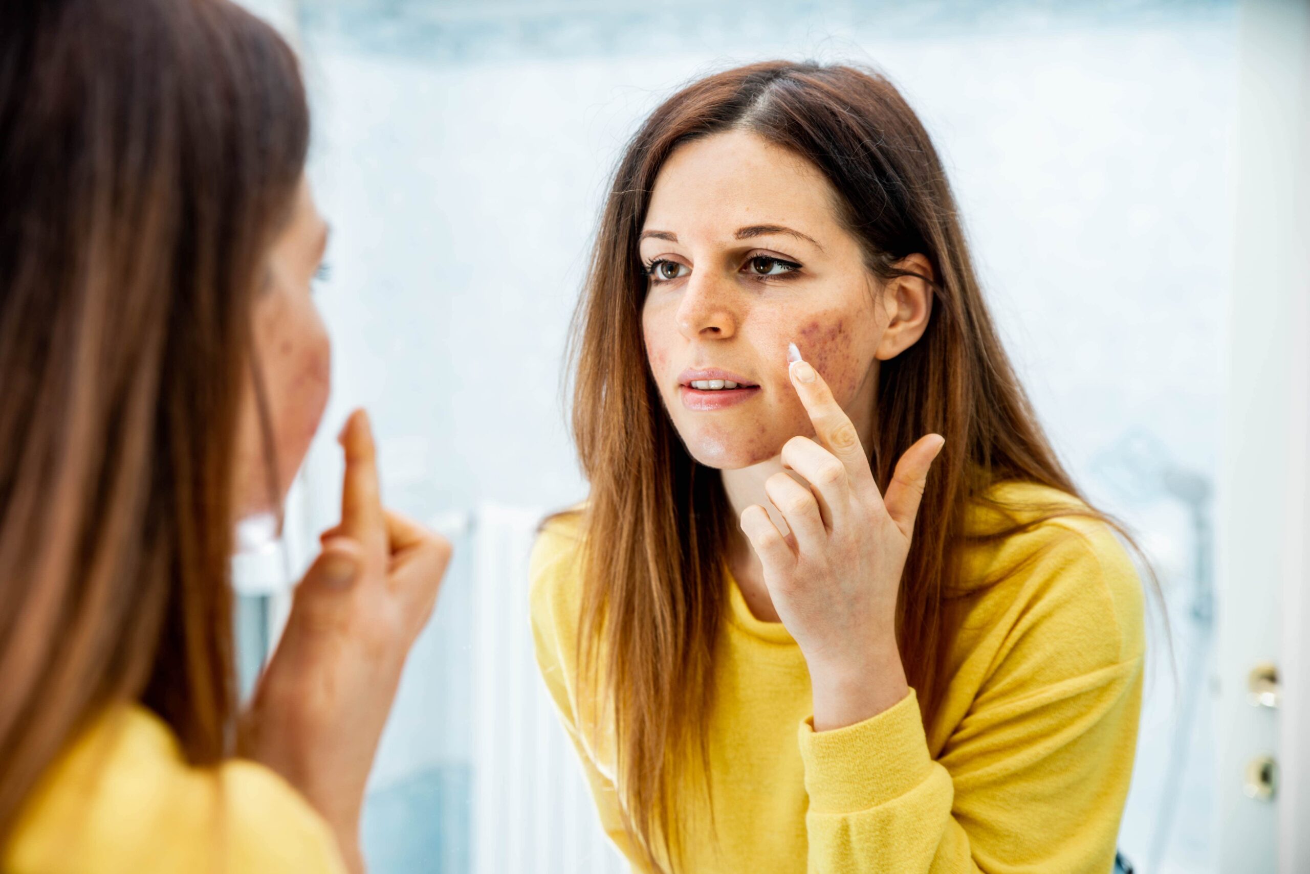Removal of Acne Scars in Kolkata