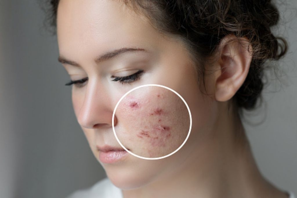 Best dermatologist in kolkata for acne scars