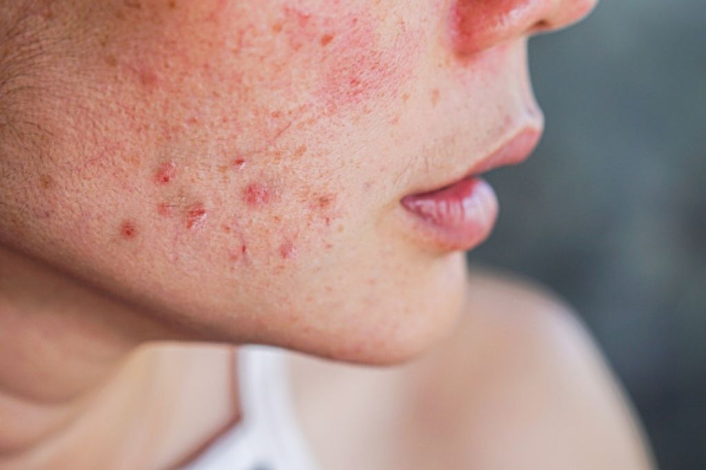 natural remedies for acne scars