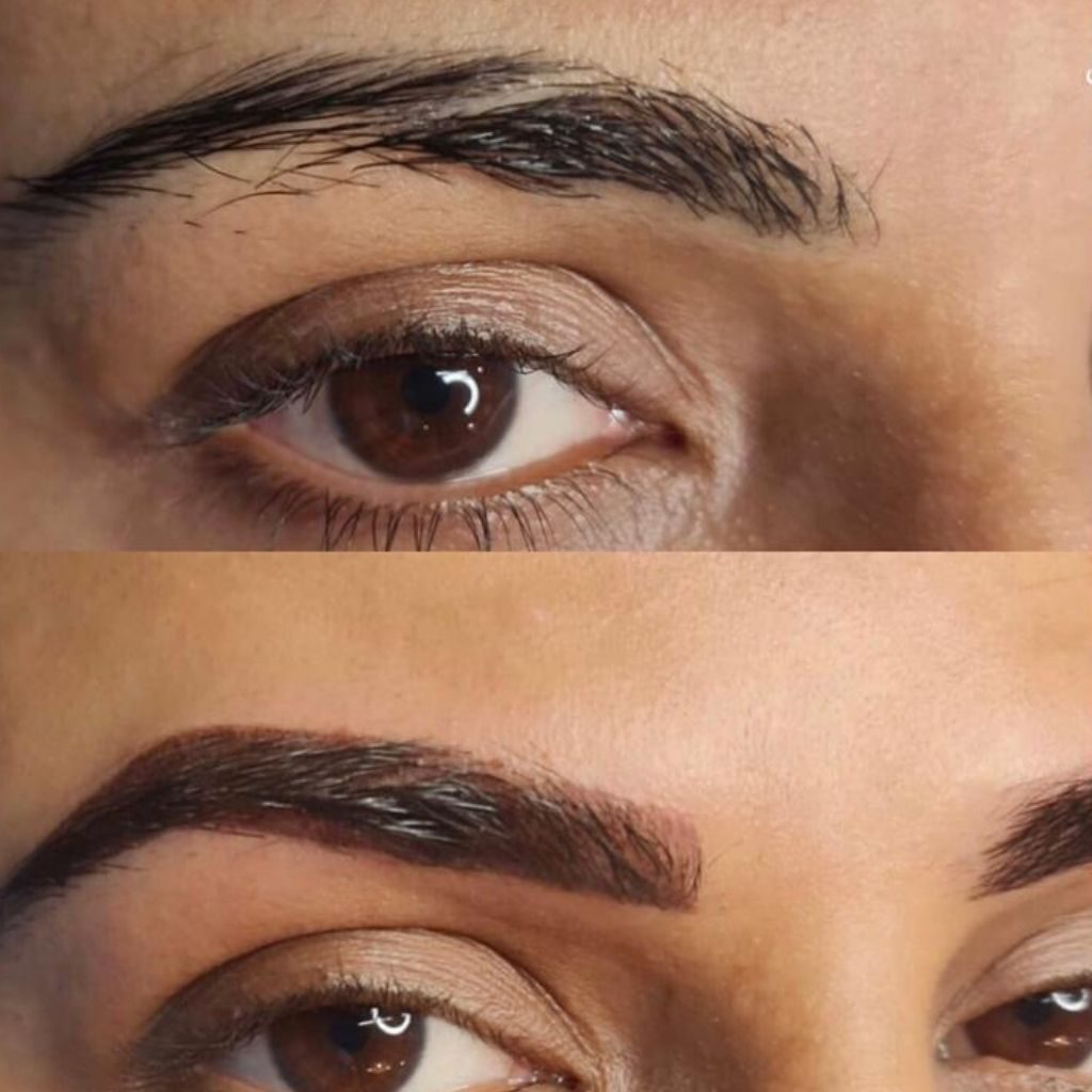 Laser treatment in kolkata