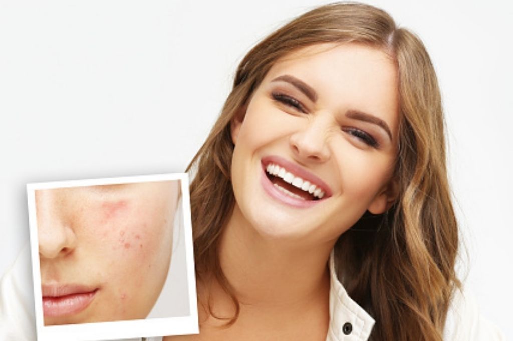 acne scars treatment