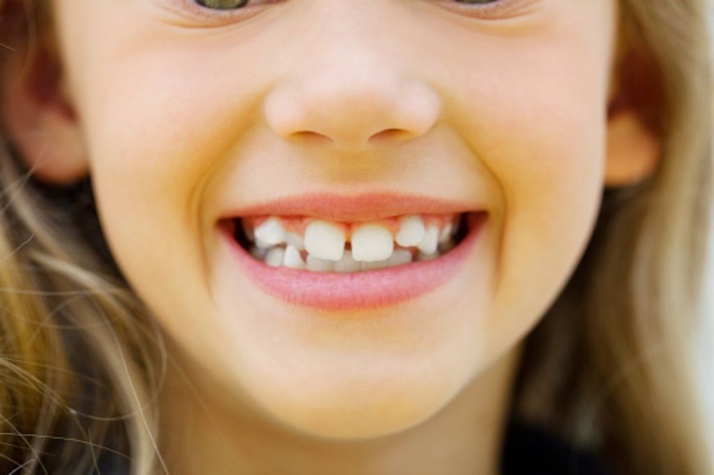 causes of crooked teeth