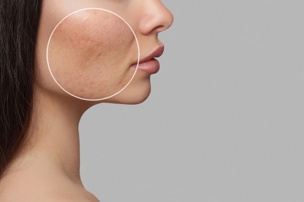 Acne scars treatment