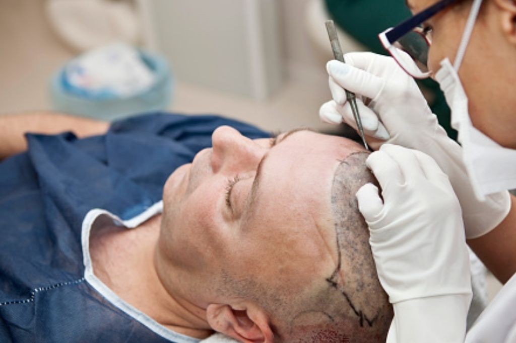 Hair transplants | hair transplant recovery