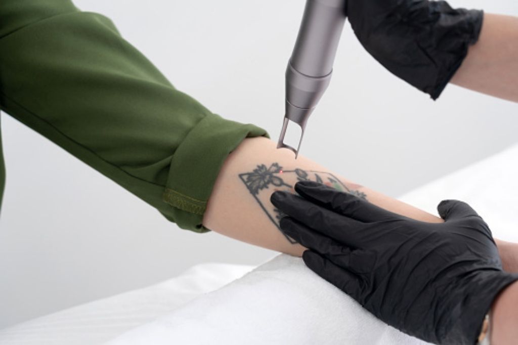 Laser Tattoo Removal