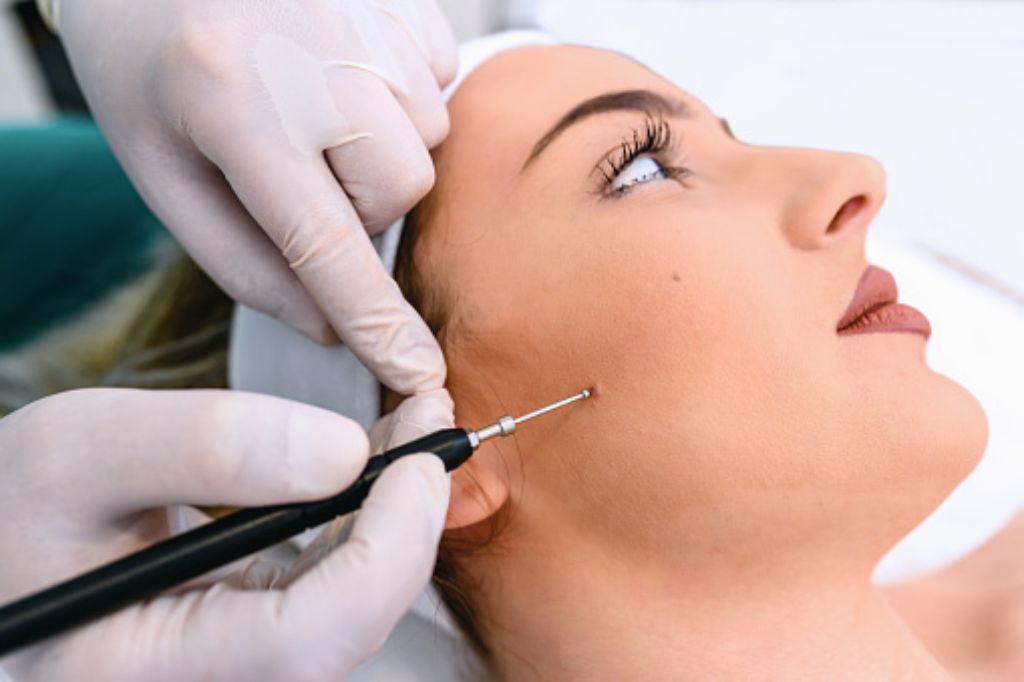 Mole Removal Treatment in Kolkata