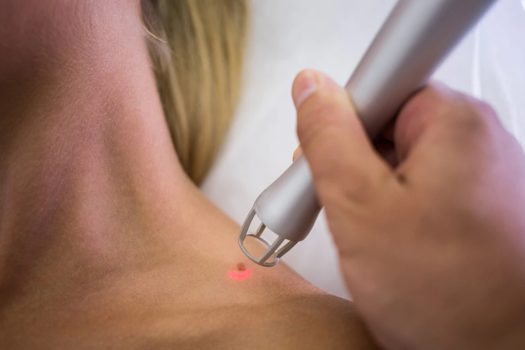 Laser Mole Removal, laser mole removal in Kolkata, mole removal treatments